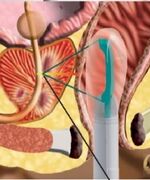 Как делают УЗИ простаты?