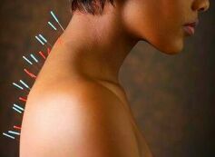 остеохандроз иглоукалывание