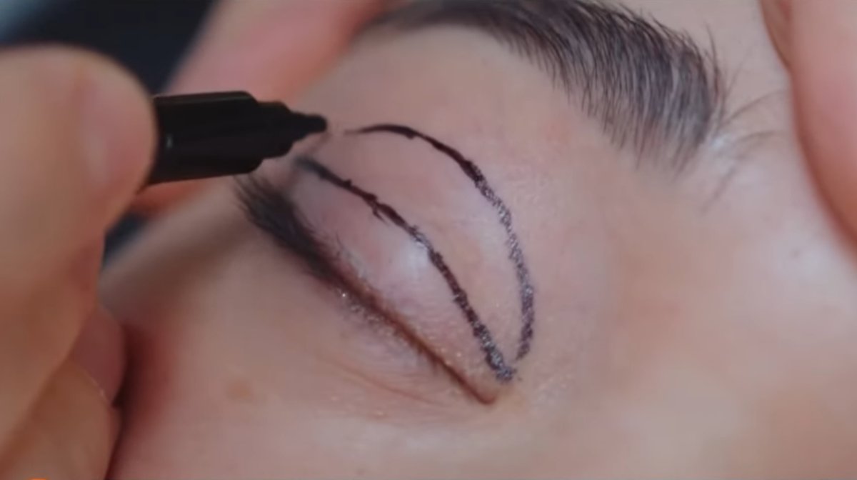 Пластическая хирургия стала новым способом вывода пенсионных средств